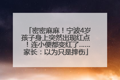 密密麻麻！宁波4岁孩子身上突然出现红点！连小便都变红了……家长：以为只是摔伤